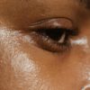 Facial Rejuvenation Acupuncture