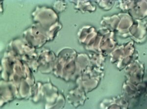 Blood cells before treatment