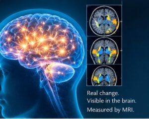 Acupuncture and brain neuroplasticity MRI